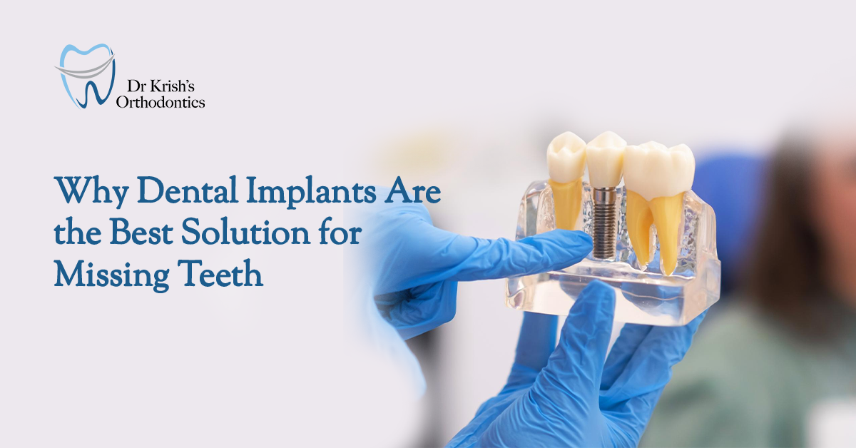 Dental Implants: The Ultimate Solution for Missing Teeth