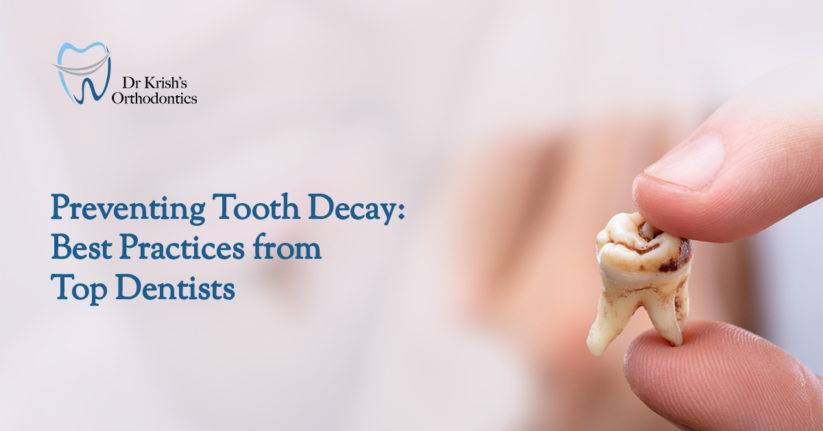 Preventing Tooth Decay: Best Practices from Top Dentists