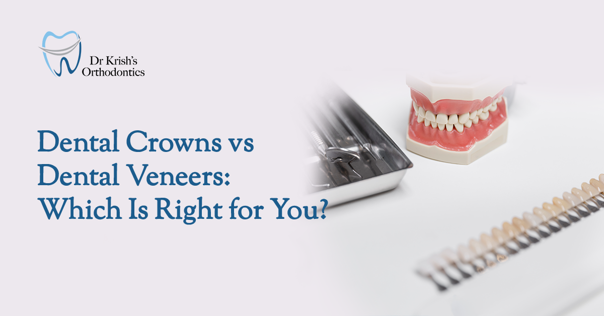 Dental Crowns vs. Dental Veneers: Which Is Right for You?